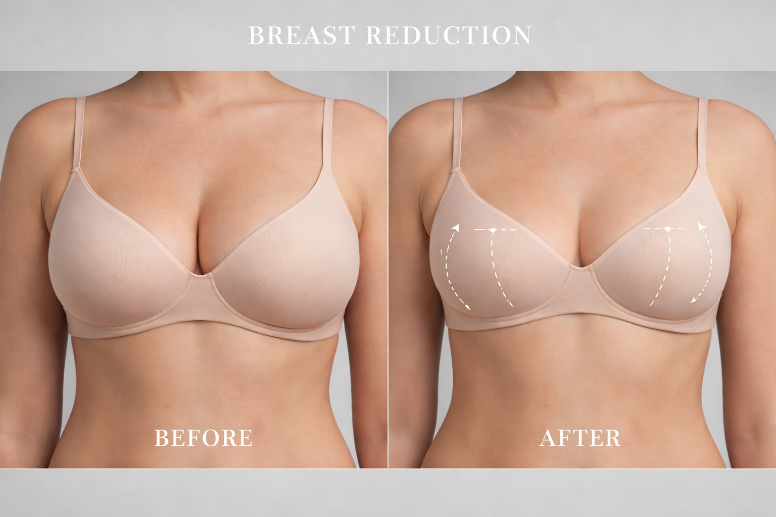 Antes y después de reducción mamaria