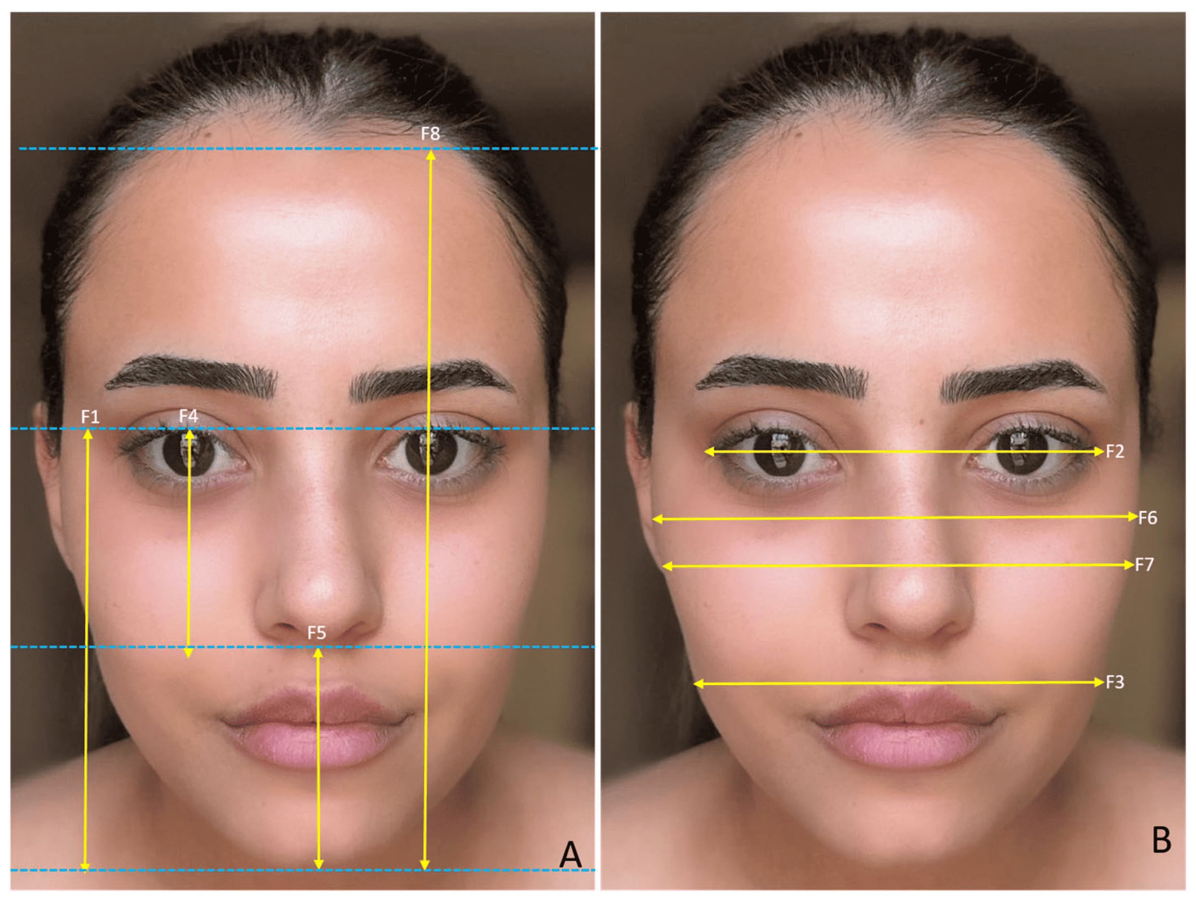 Beneficios del Lifting Facial y Armonía