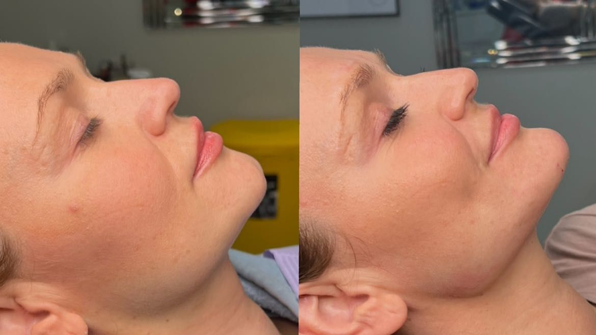 Resultados de Rinoplastia Antes y Después