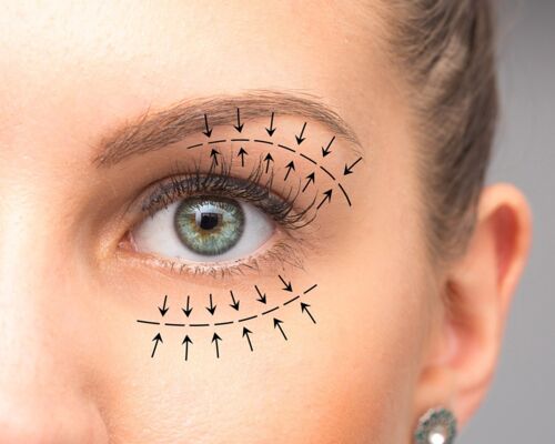 Beneficios de la Blefaroplastia